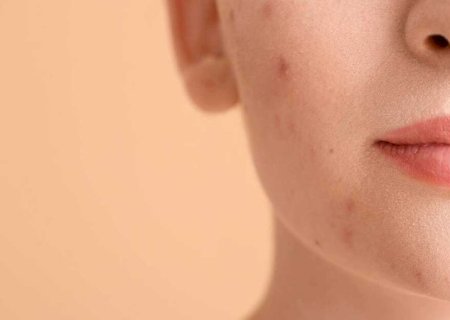 Acne hormonal: entenda as causas