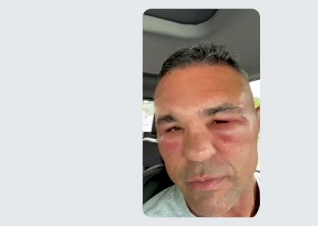 Vitor Belfort aparece com rosto inchado e culpa implante capilar