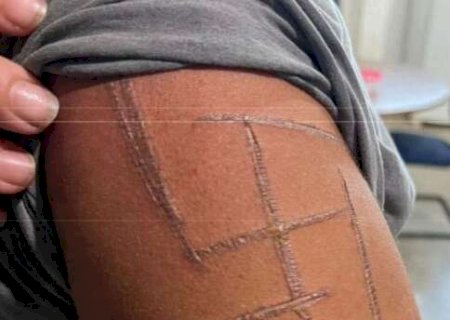 &ldquo;Achei que iam me matar&rdquo;, diz mulher trans espancada e marcada com su&aacute;stica