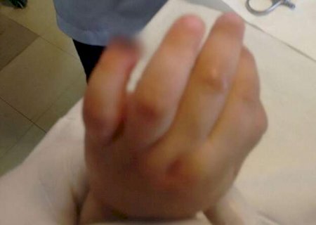 Sobe para R$ 25 mil indeniza&ccedil;&atilde;o por crian&ccedil;a que teve dedo amputado em Emei