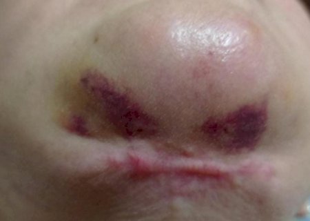 Cl&iacute;nica e dentistas s&atilde;o condenadas ap&oacute;s cirurgias est&eacute;ticas deformarem rosto