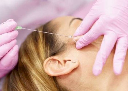 Mulher ganha indeniza&ccedil;&atilde;o ap&oacute;s ter rosto deformado por fios de rejuvenescimento